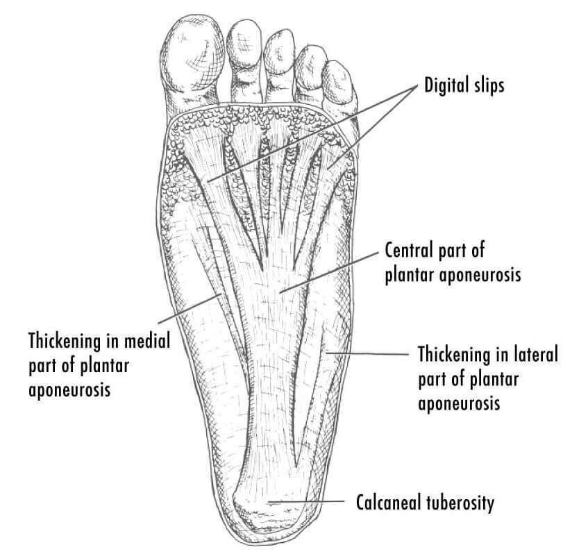 Graphic depicting where plantar fasciitis happens on the bottom of the foot. It points out that the plantar aponeurosis runs the length of the foot, from heel to toes, and the later and medial parts of the plantar aponeurosis would thicken during plantar fasciitis.